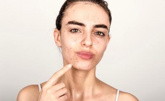 Acne scars