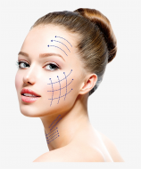 PDO Threadlift
