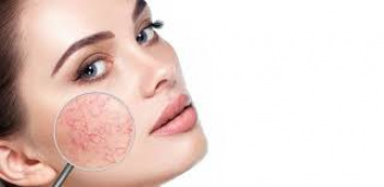 Broken capillaries on the face