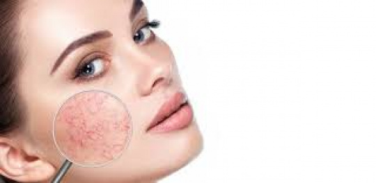 Broken capillaries on the face