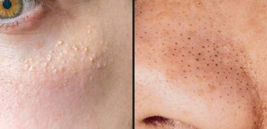 Whiteheads and Blackheads