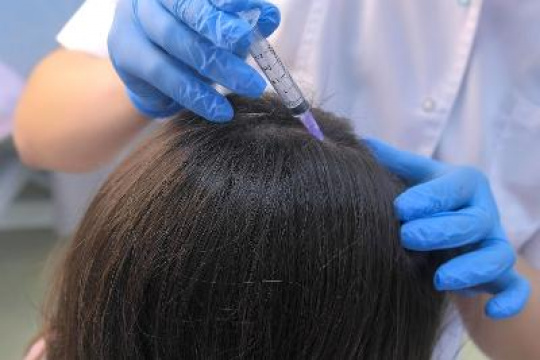 Alopecia and hair loss