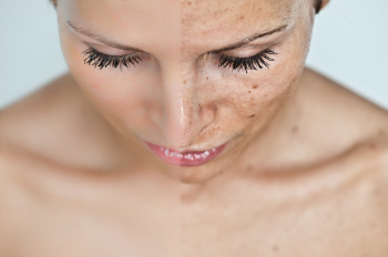 Skin Discoloration & Hyperpigmentation